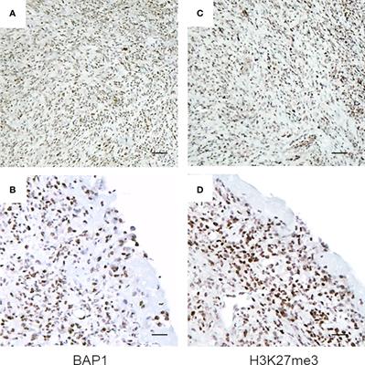 CDKN2A Determines Mesothelioma Cell Fate to EZH2 Inhibition